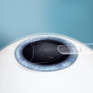 EVO ICL lens placement illustration