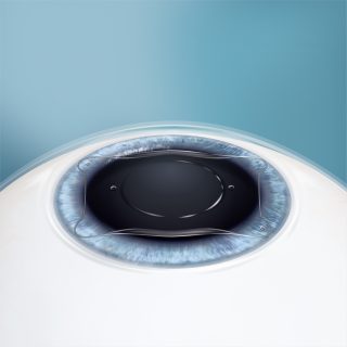 Clear vision after EVO ICL illustration