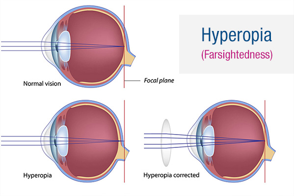Farsightedness (Hyperopia) diagram