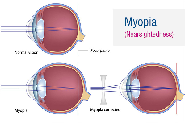 Nearsightedness (Myopia) diagram