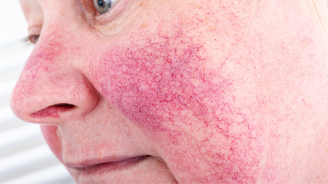 Intense Pulsed Light therapy can treat rosacea