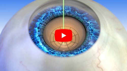 The LENSAR Laser System offers precise cataract removal
